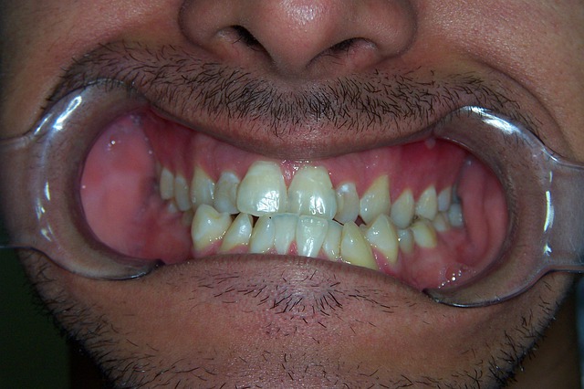homme avec dents jaunes